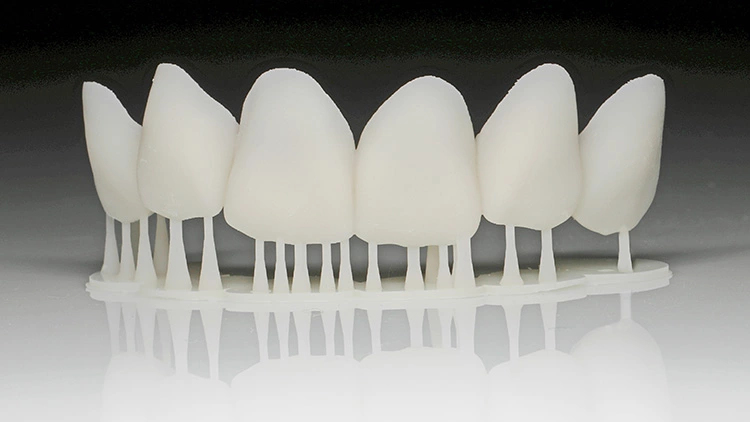 Gedruckte Schalenprovisorien sind eine eklatante Verbesserung des klinischen Workflows; sie werden bald aus dem Alltag der digitalen Praxis nicht mehr wegzudenken sein.