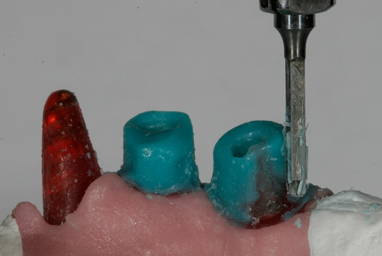 Abb. 52: Wachsfräsen der Abutments mit Stufe.