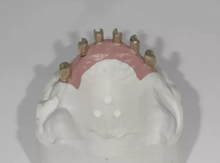 Abb. 54: Kontrolle auf dem Modell bezüglich der Lage und Stufenausformung.