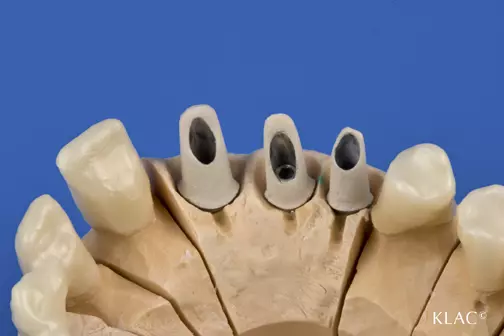 Abb. 5: Titan-Abutments, mit Cristobal-Opaker beschichtet.