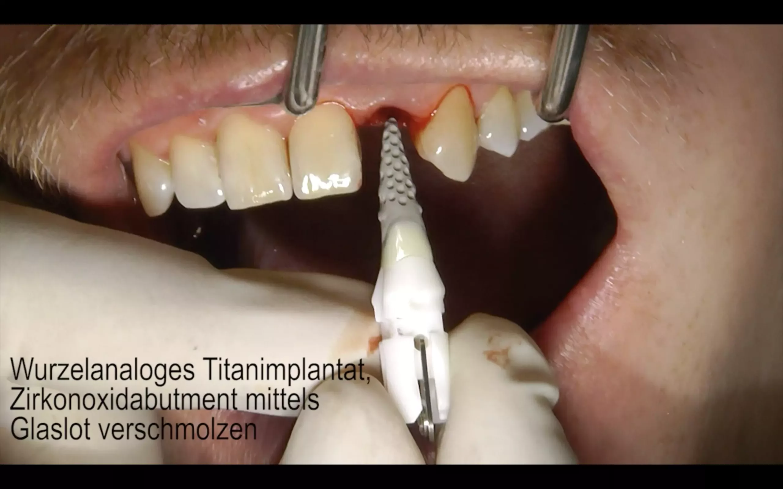 Abb. 4: Wurzelanaloges Titanimplantat mit Zirkonoxid-Abutment, mit Glaslot verschmolzen. Die Oberfläche des Titanteils begünstigt das Einwachsen von Knochensubstanz.