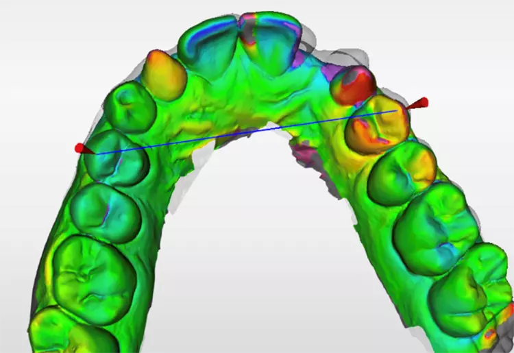 Abb. 6: OraCheck-Analysemodell für eine KfO-Planung. Durch zeitliche Erfassung und Überlagerung von Modellen detektiert OraCheck Erosionen, Abrasionen, Zahn-wanderungen, Zahnfleischveränderungen, Abplatzungen u.a.