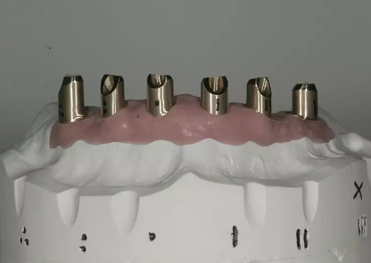 Abb. 60: Fertige Abutments im OK mit provisorischer Kennzeichnung.