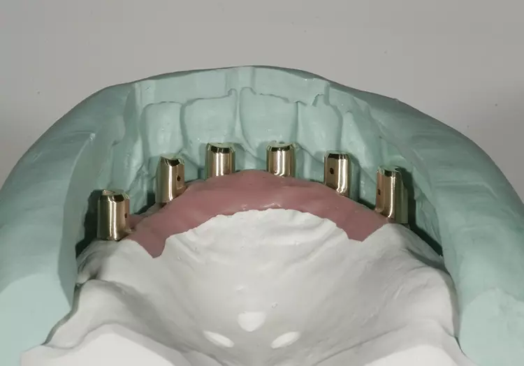 Abb. 61: Letzte Kontrolle der Platzverhältnisse von labial.