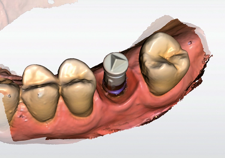 Abb. 7: Scanbody zur digitalen Abformung der enossalen Pfeilerposition und Übertragung auf das Meistermodell mit periimplantären Strukturen, ausgeführt mit der Cerec-Software.