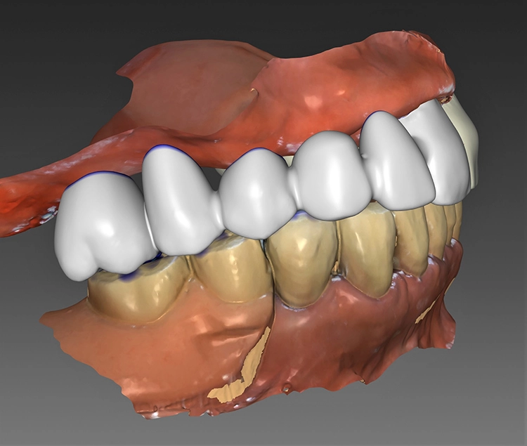 Abb. 6: Virtuelle prothetische Planung für implantatgetragene Brücken, regio 11–16 und 21–26.