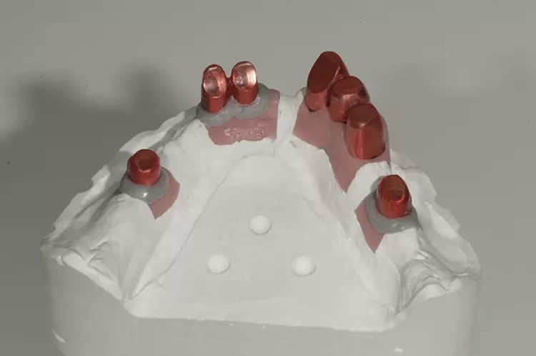 Abb. 70: Implantatschürzen basal anmodelliert