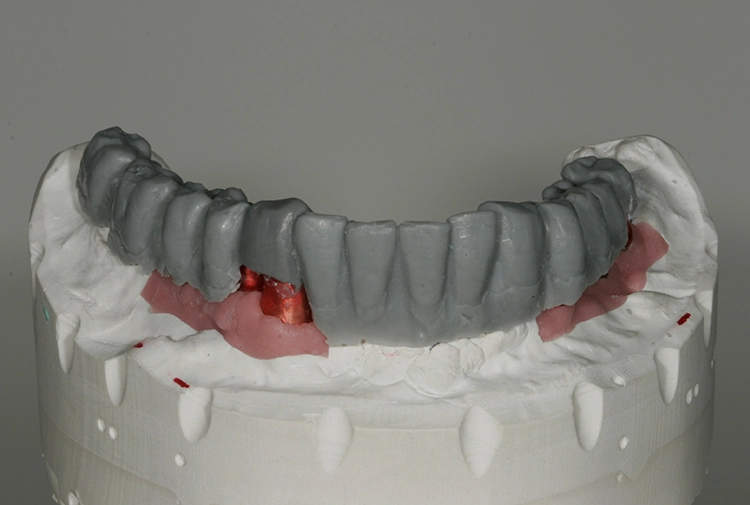 Abb. 72: Schnelles und effizientes Wax-up.