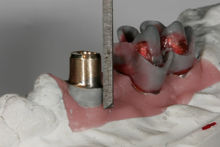 Abb. 78: Ausblocken untersichgehender Bereiche Implantat 34.