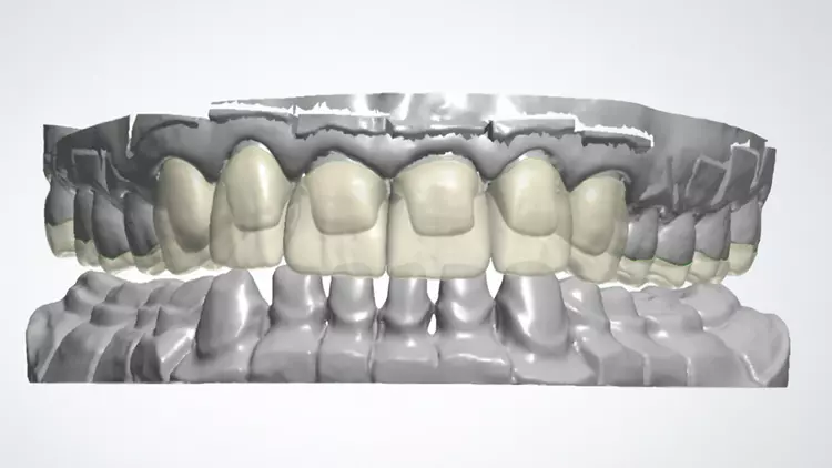 Abb. 7: Präparation und virtuelle Konstruktion (3shape) von Kronen, Teilkronen und Okklusal-Veneers.
