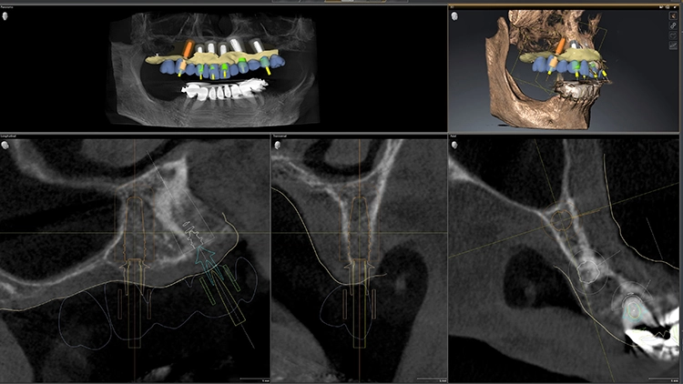 Abb. 7: Implantologische Rückwärtsplanung im DVT: Positionierung der enossalen Pfeiler nach Matching des Kieferscans inklusive Brückenkonstruktion. Danach erfolgt die korrekte Implantatplanung (Stellung, Länge, Durchmesser) zusammen mit entsprechenden Abutments und den Hülsen für die Implantat-Positionierungsschiene (Software Sicat Implant).