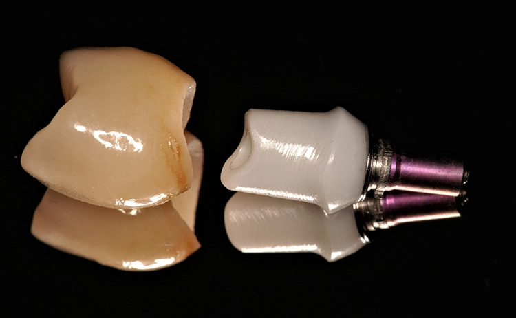 Abb. 8: Hybrid-Abutment mit ausgeformtem Emergenzprofil und Krone zur Verschraubung mit dem Enossalpfeiler.