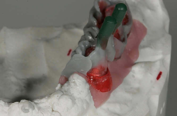 Abb. 80: Lötfläche im Gingivaverlauf vergrößert.