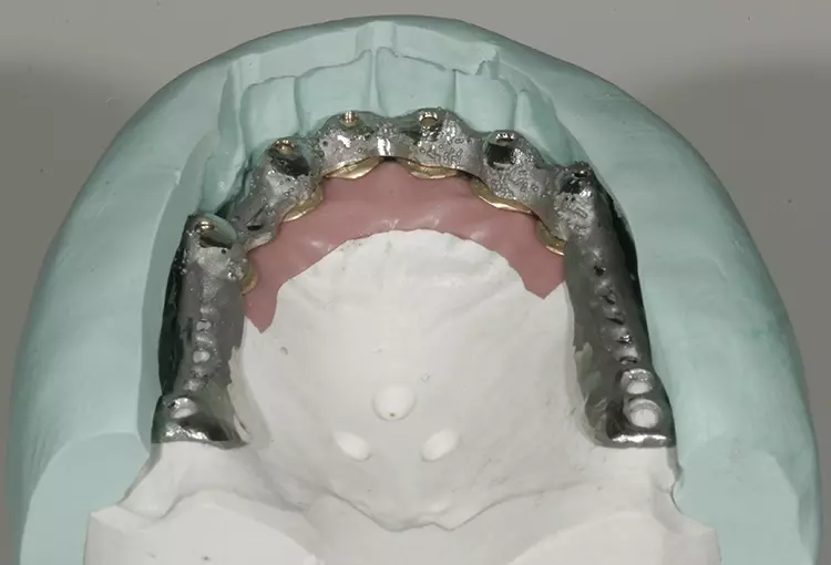 Abb. 93: Kontrolle der Platzverhältnisse von labial und palatinal