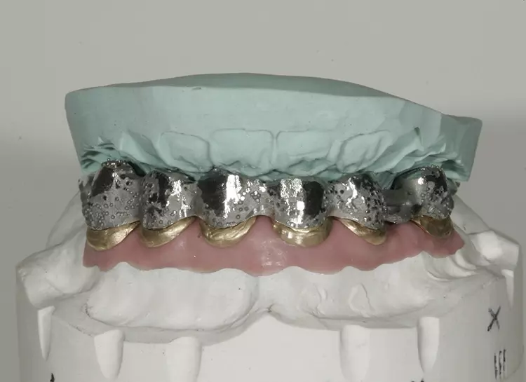Abb. 94: Kontrolle der Platzverhältnisse von labial und palatinal