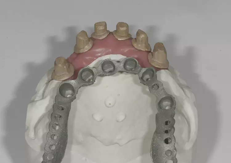 Abb. 96a: Käppchen und Suprakonstruktion sandgestrahlt und im Detail.