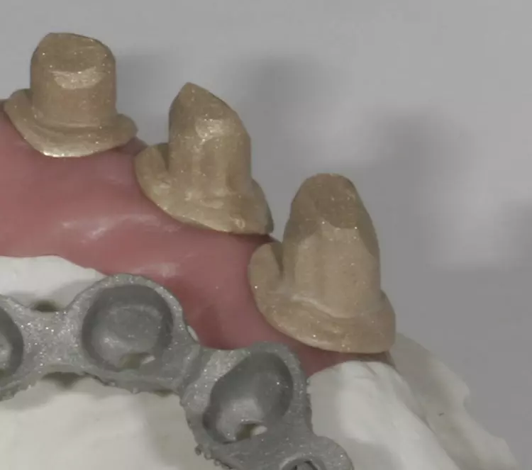 Abb. 96b: Käppchen und Suprakonstruktion sandgestrahlt und im Detail.