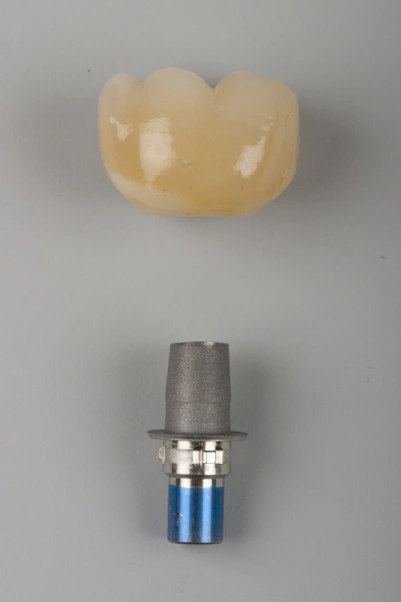 Abb. 9: Hybrid-Abutment mit präfabrizierter Titanbasis und Vollkeramikkrone.