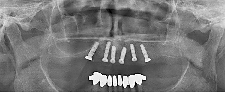 Abb. 9: Röntgenkontrolle der korrekt inserierten Implantate.