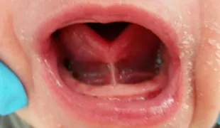 Abb. 1: Herzzunge bei Frenulum linguae.