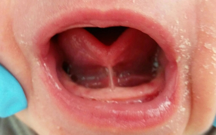 Abb. 1: Herzzunge bei Frenulum linguae.