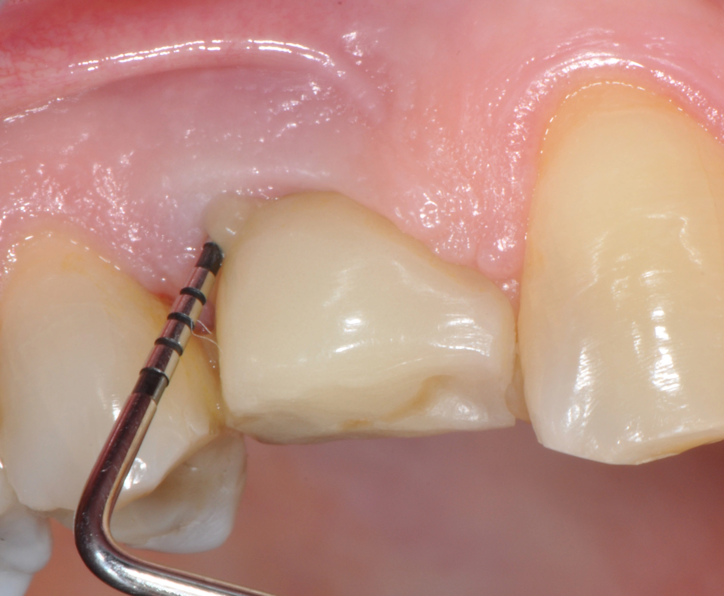 Abb. 1: Bei der periimplantären Sondierung finden sich eine Sondierungstaschentiefe (PPD) von 9 mm und Eiter.