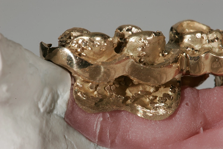 Abb. 100: Die Implantatschürzen Regio 36/37.