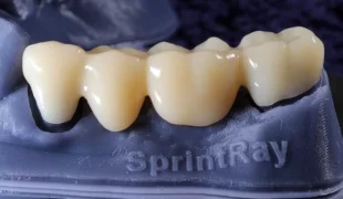 3D-gedruckte, semipermanente Seitenzahnbrücke aus Komposit