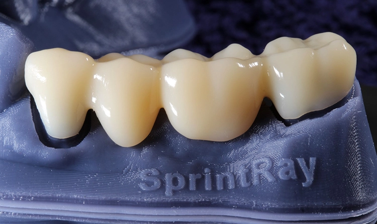 3D-gedruckte, semipermanente Seitenzahnbrücke aus Komposit