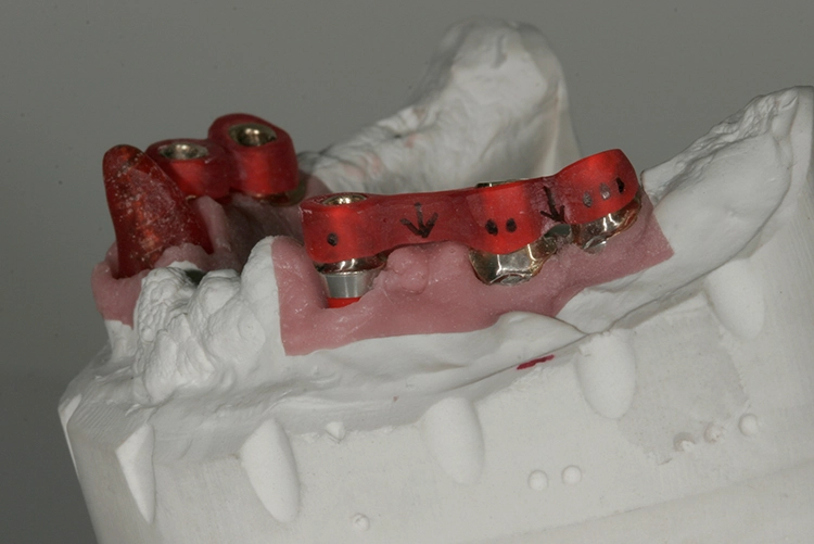 Abb. 103: Einsetzhilfen für den Zahnarzt mit Markierungen.
