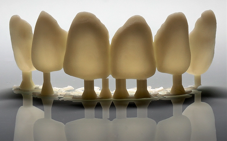 Abb. 6: Schalen-Provisorien aus dem 3D-Drucker.