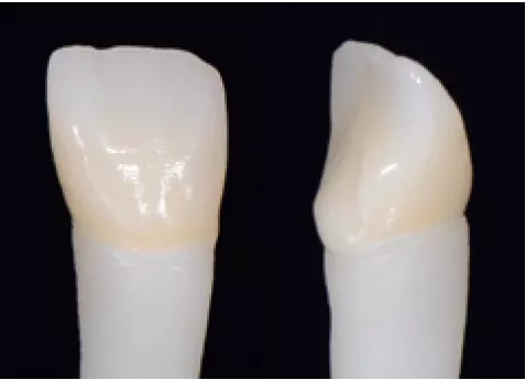 Abb. 2d: Die Finalisierung in Maltechnik mit IPS Ivocolor erfolgt auf einem dem natürlichen Pfeiler nachempfundenen Stumpf aus IPS Natural Die Material.