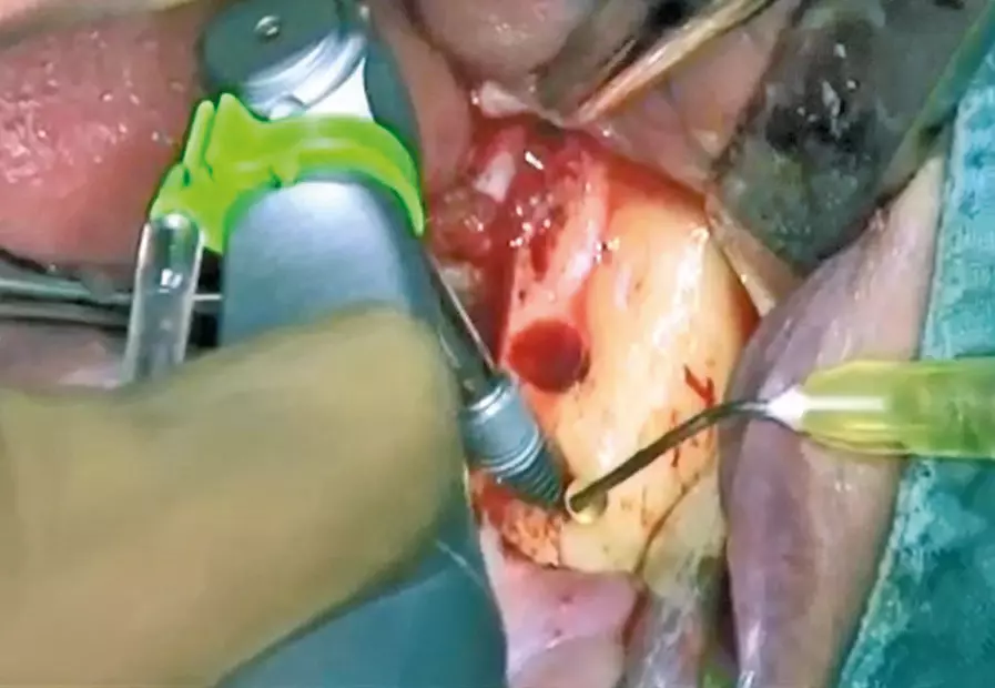 Abb. 10: Während der Insertion des Implantats wurde die Oberfläche mit PRGF benetzt.