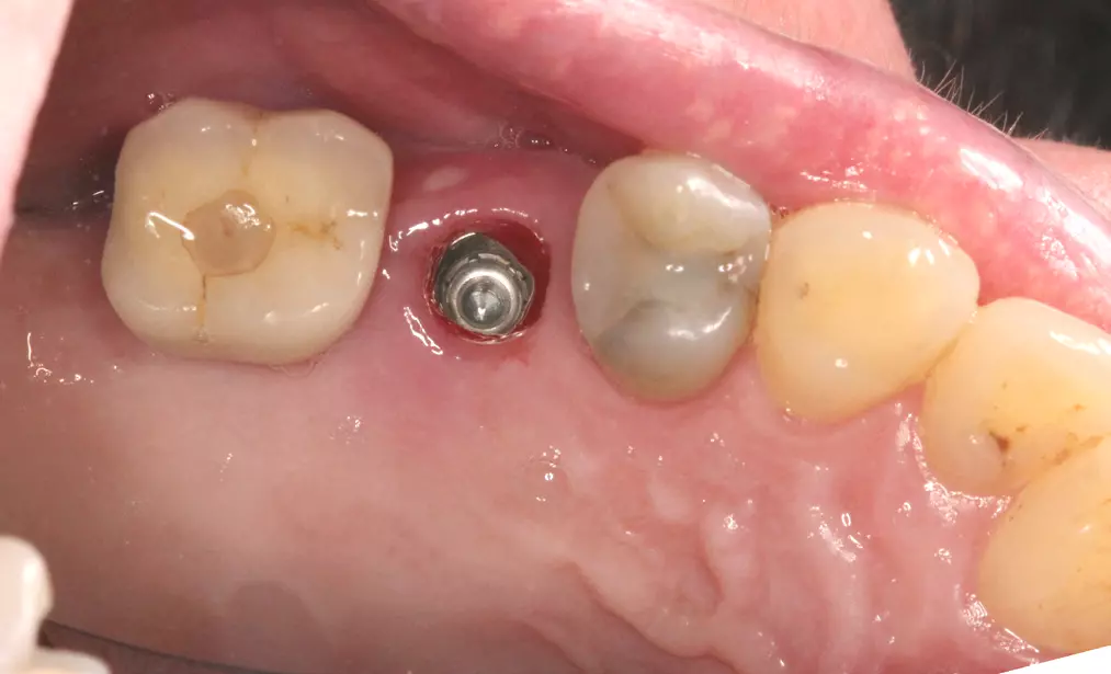 Abb. 10: Implantat regio 15 nach der Osseointegration. Nach dem Aufbringen des Scanpfostens wird die Situation mit dem Intraoralscanner erfasst.