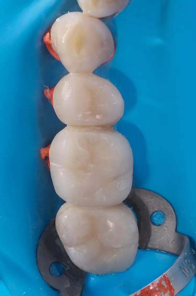Abb. 10: Implantatvorplanung für die geführte Chirurgie.