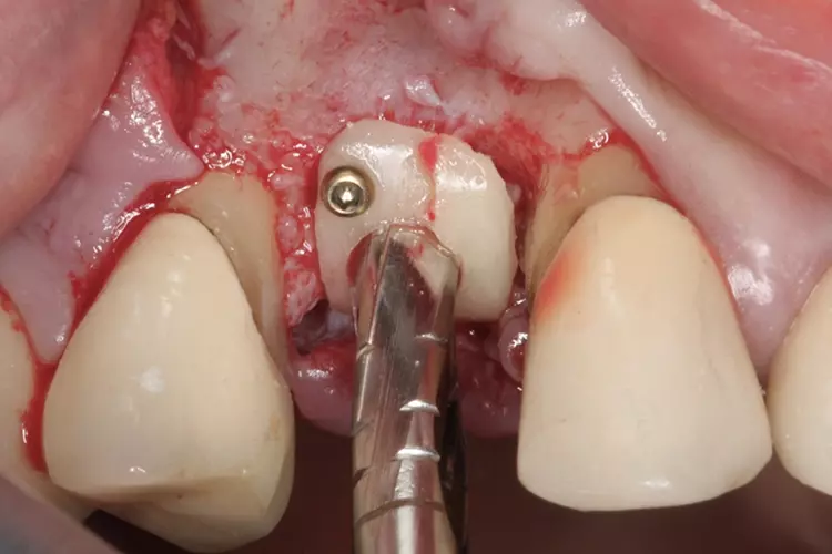 Abb. 9: Die Knochenschale wird mit ihrer abgerundeten Seite nach oben mit Osteosyntheseschrauben
fixiert. Danach erfolgt die Perforation der Schale mittels eines
Trepans entsprechend dem Durchmesser des Implantats, das inseriert werden soll.