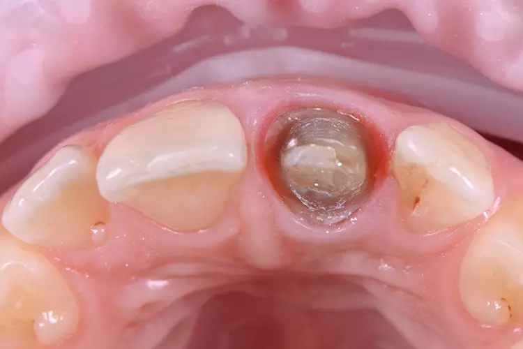 Abb. 10: Mittels guter Randgestaltung der provisorischen Krone und einer engagierteren
häuslichen Zahnpflege ließ sich eine reizfreie, straffe und gesunde
Gingiva erzielen.