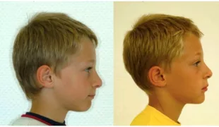 Profilfotografie vor (links) und nach Insertion der FPOs (rechts) – deutliche Verbesserung des Profils inkl. der Lippenlinie und der Inklination der Kopfhaltung [47].