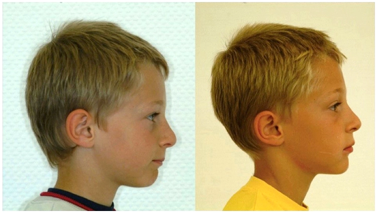 Profilfotografie vor (links) und nach Insertion der FPOs (rechts) – deutliche Verbesserung des Profils inkl. der Lippenlinie und der Inklination der Kopfhaltung [47].