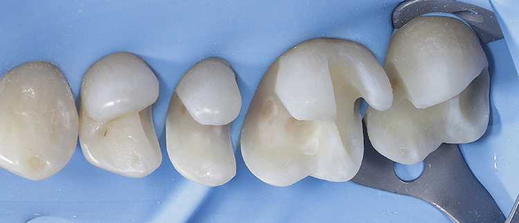 Abb. 10: Zustand nach kinetischer Kavitätenpräparation (mit Al2O3) und Air-Polishing (mit Glycinpulver), Ansicht von palatinal.