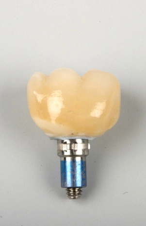 Abb. 10: Hybrid-Abutment, okklusal mit Krone verschraubt.