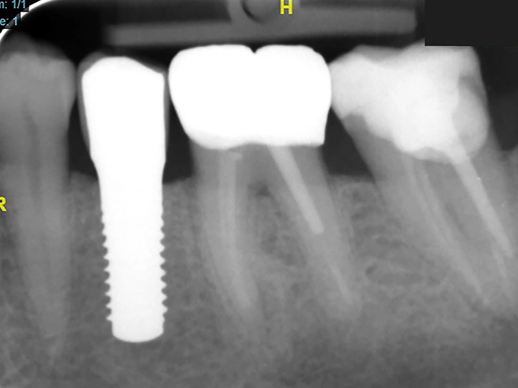 Abb. 10: Radiologische Kontrolle, 4,5 Jahre nach Implantation.