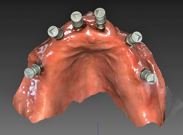 Abb. 10: Digitalisierung der Implantatposition durch Scanbodies, eingebracht im Klicksystem (iSy Implantat/Camlog).