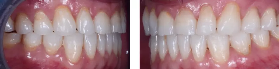 Abb. 10: Behandlungsphase 1 von 2: nach Abschluss mit Invisalign®, Lateralansicht.