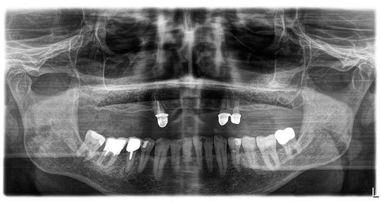 Abb. 10: Röntgenkontrollaufnahmen unmittelbar nach beidseitiger Sinusbodenelevation.
