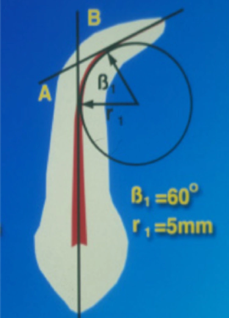 Abb. 10a: Gleicher Krümmungswinkel, aber unterschiedlicher Krümmungsradius (r1 = 5 mm).