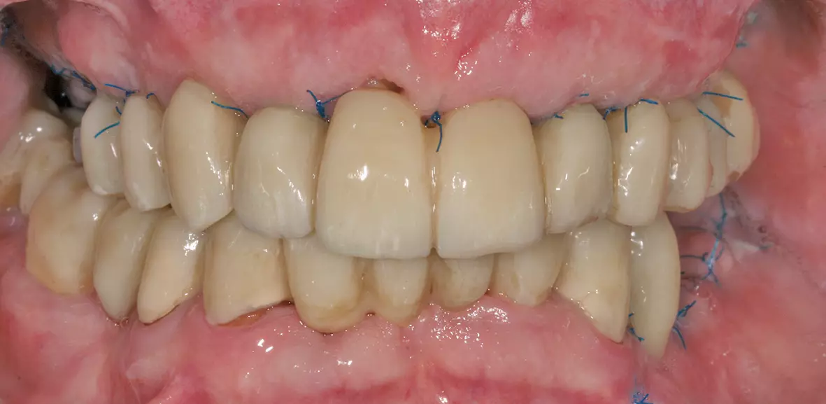 Abb. 10b: Situation zwei Wochen nach Operation (retrahierte Lippen).
