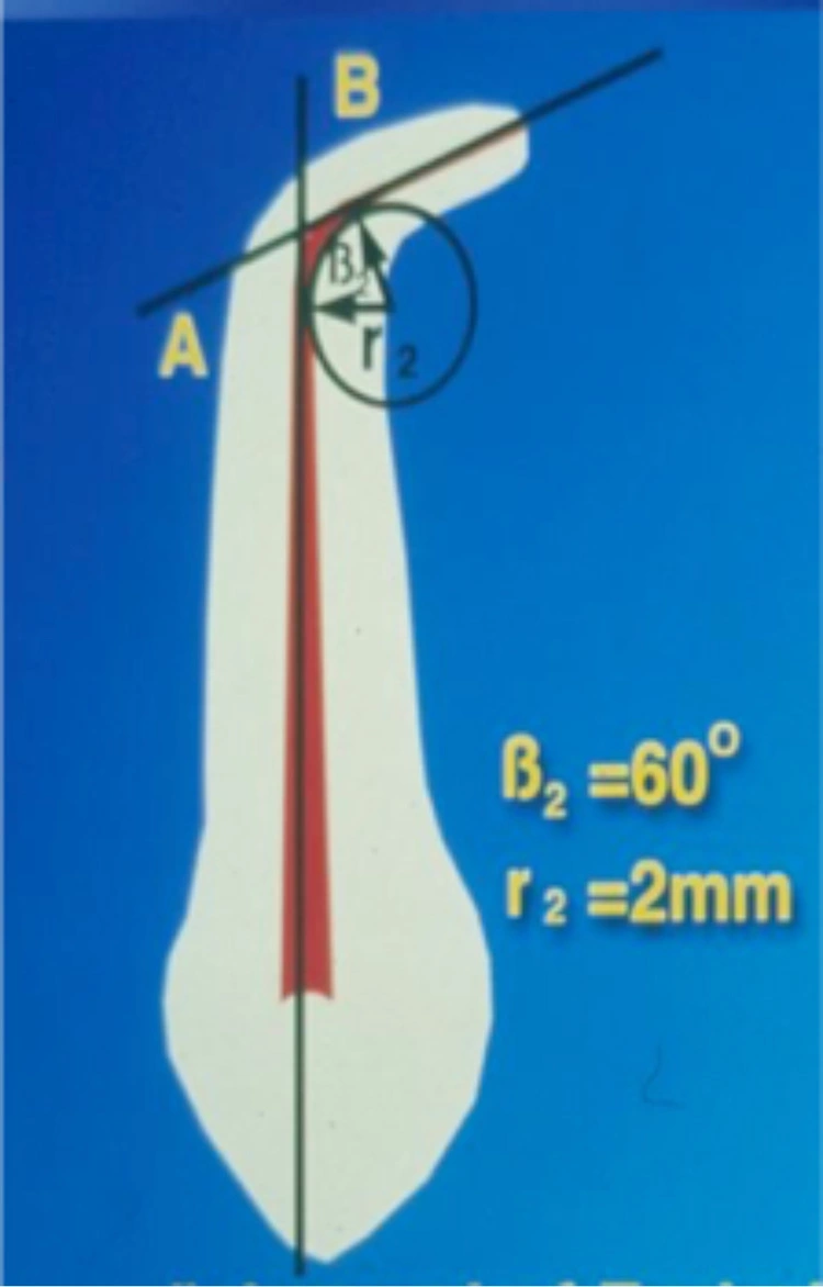 Abb. 10b: Gleicher Krümmungswinkel, aber unterschiedlicher Krümmungsradius (r2 = 2 mm).