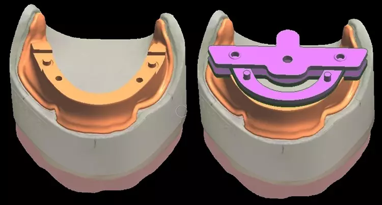 Abb. 11: Unterkiefermodell mit individuellem Löffel inkl. virtuellem Stützstiftregistrat.