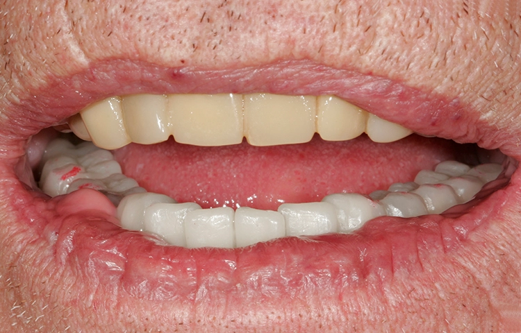Abb. 110: Der Lippenverlauf im Mund.